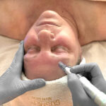 Microneedling
