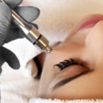 Mikrodermabrasion